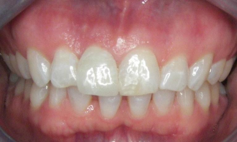 Dental-Implant-and-Bonding-After-Image