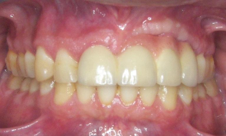 Implants-After-Image