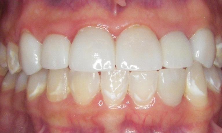 Crowns-After-Image