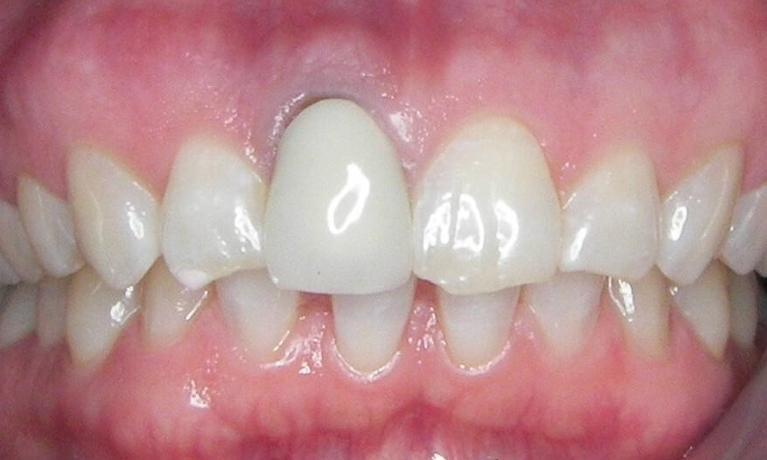 Dental-Implant-and-Bonding-Before-Image