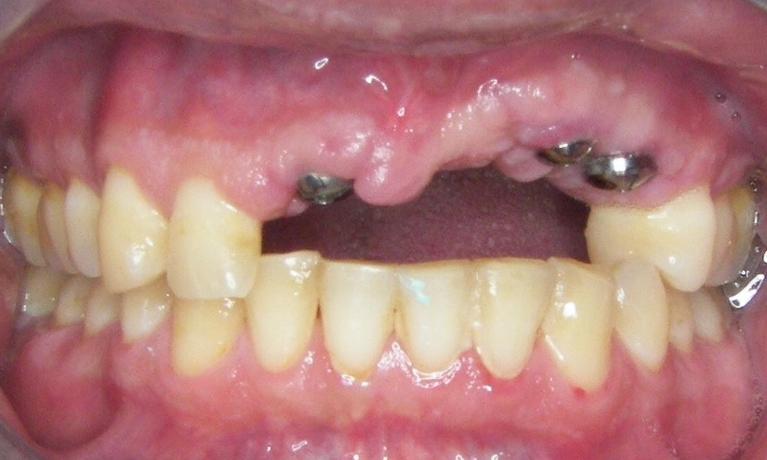 Implants-Before-Image